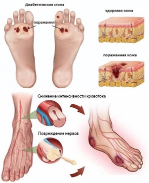диабетическая стопа диабетическая стопа