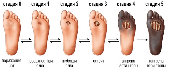 Диабетическая стопа